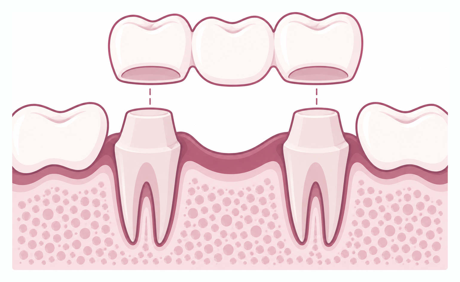 Diagram of a three-unit dental bridge anchored on crowned teeth either side of a gap