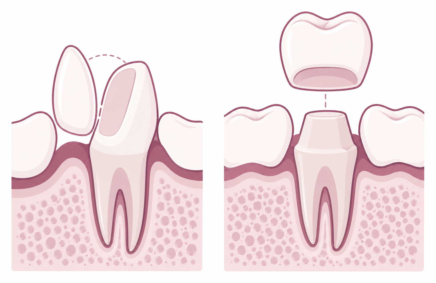 Diagram comparing a thin porcelain veneer on the front of a tooth with a full-coverage crown